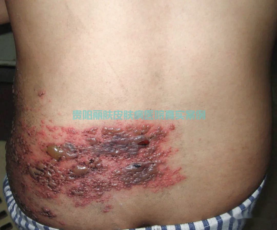 带状疱疹案例