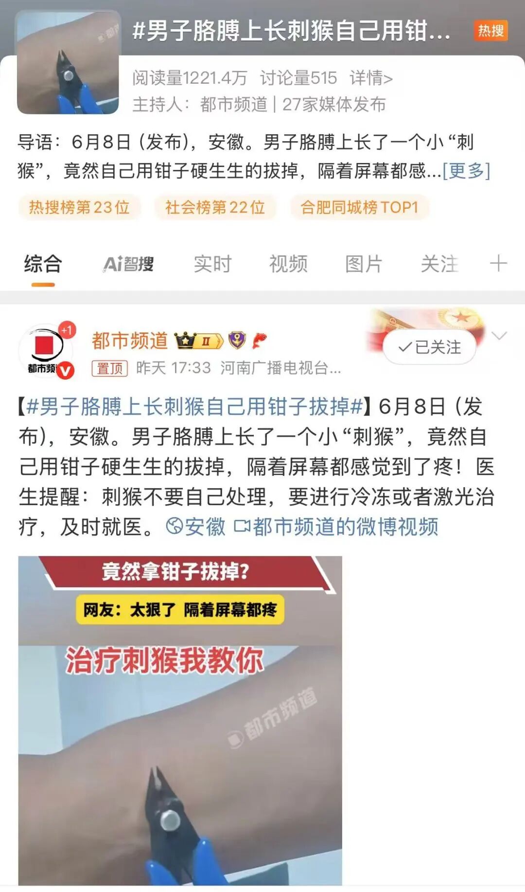 是个狠人！男子胳膊上长“刺猴”，自行用钳子拔掉！皮肤科医生：