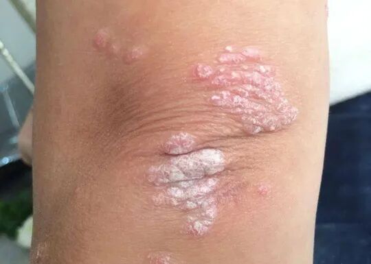 从中医的角度详细分析寻常型银屑病，全方位助力有效防治！