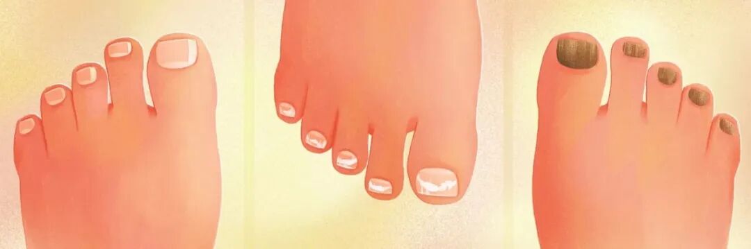 灰指甲能自愈吗？什么人群最容易中招？解析灰指甲的秘密