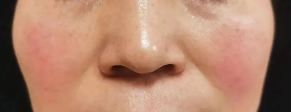 脸上红、肿、痒，用了过敏药怎么都不好？小心这个隐藏在生活中的